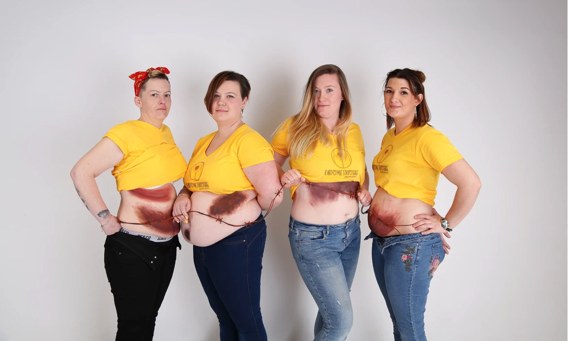 Endometriosis Team